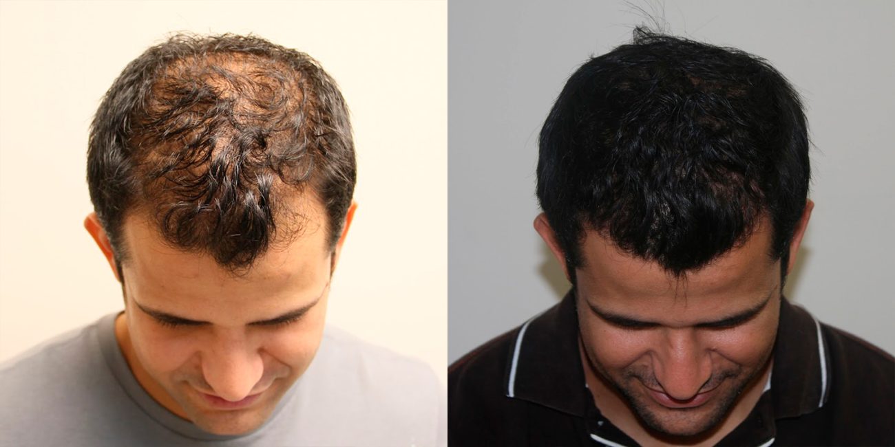 Minoxidil before and after 6 months