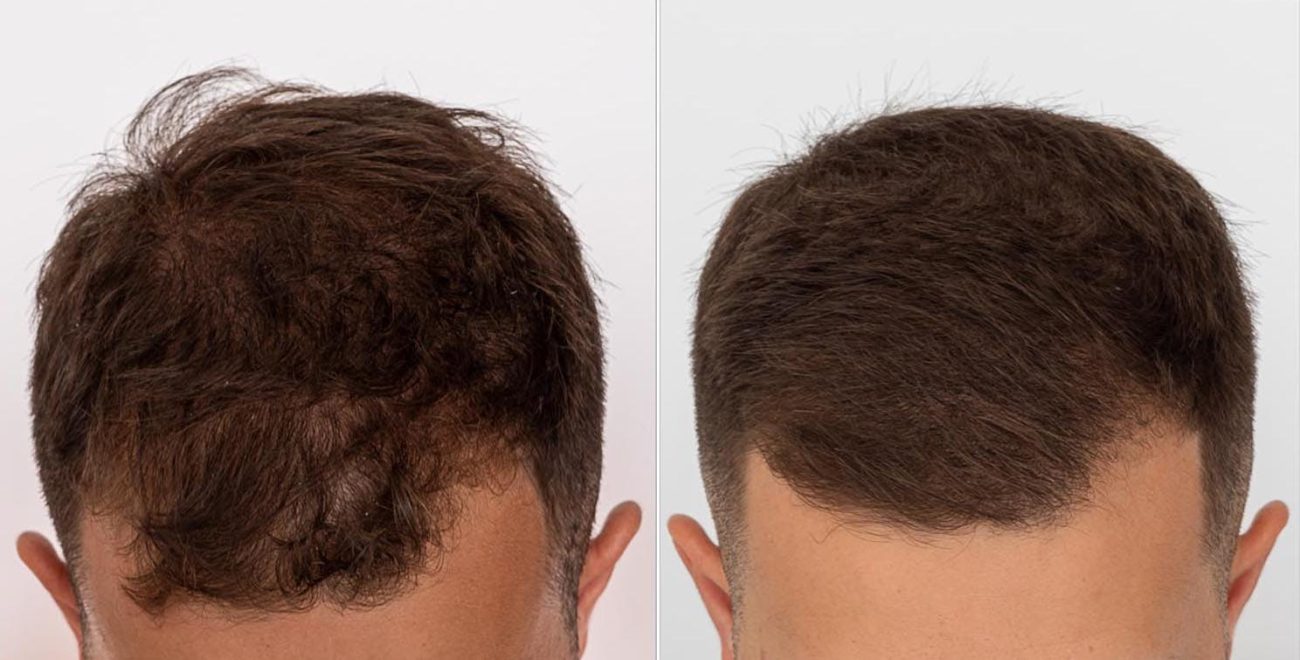 Minoxidil-before-and-after-header